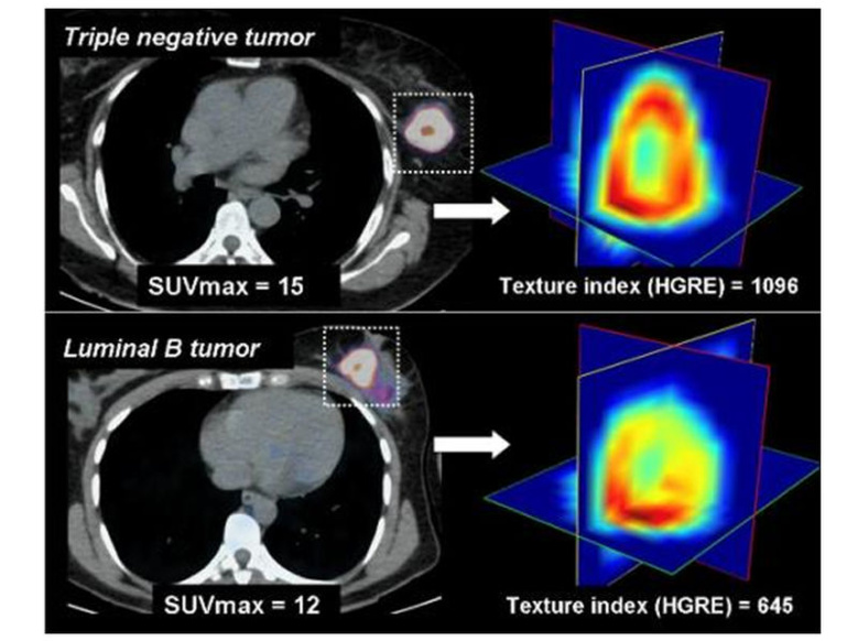 Cancer du sein : l'imagerie de plus en plus intelligente (suivi, pronostic et prédiction de toxicité)